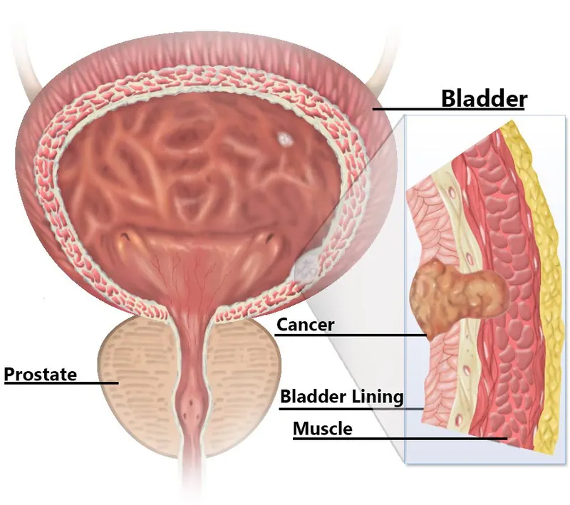 Ilustração da notícia: Câncer de bexiga que atinge o músculo exige quimioterapia e cirurgia, dizem diretrizes